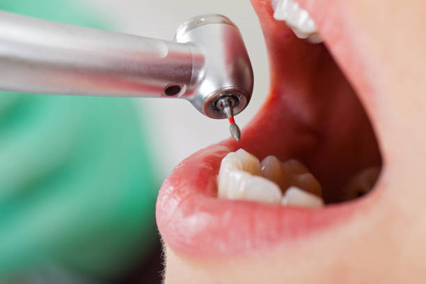 Best Emergency Root Canal Treatment in Edgerton, WI